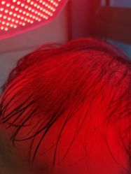 -碧莲盛·不剃发植发