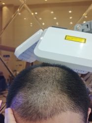 -碧莲盛·不剃发植发