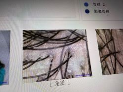 -大麦微针植发全国连锁