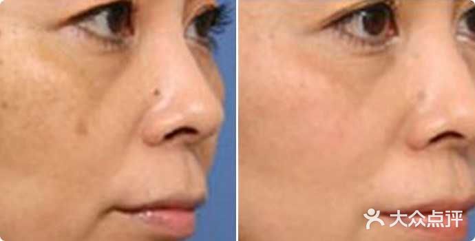 激光点痣E光祛斑 皮秒激光 激光去纹身