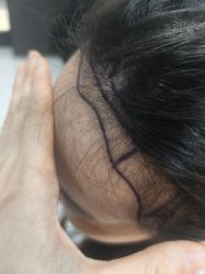 -碧莲盛不剃发植发