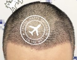 -大麦微针植发全国连锁