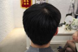 点击看大图 -大麦微针植发丨全国连锁