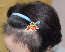 -大麦微针植发全国连锁
