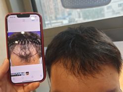 -碧莲盛·不剃发植发