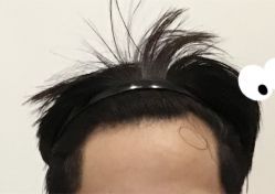 -大麦微针植发全国连锁