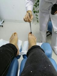 -派恩宜灰指甲鸡眼嵌甲手足癣