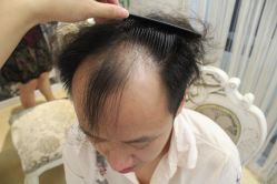 点击看大图 -大麦微针植发丨全国连锁