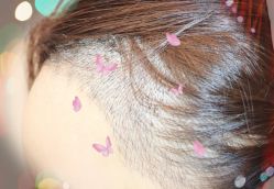 -大麦微针植发全国连锁