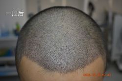 体验后-大麦微针植发全国连锁