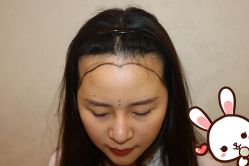 点击看大图 -大麦微针植发丨全国连锁