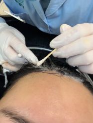 -碧莲盛·不剃发植发