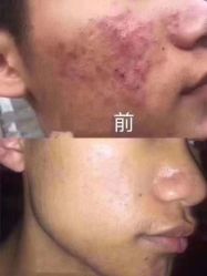 -瑶芳清颜草本祛痘
