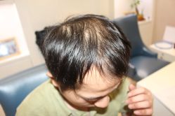 -大麦微针植发丨全国连锁