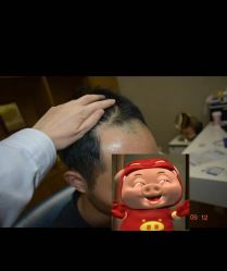 -大麦微针植发全国连锁