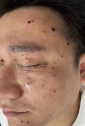-北京美痣堂古方祛痣斑疣瘊
