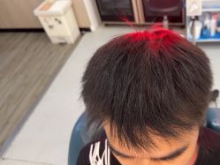 -大麦微针植发全国连锁