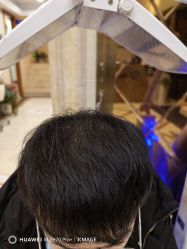 -碧莲盛·不剃发植发