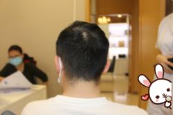 -大麦微针植发丨全国连锁