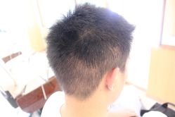 点击看大图 -大麦微针植发丨全国连锁