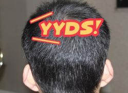 -大麦微针植发丨全国连锁