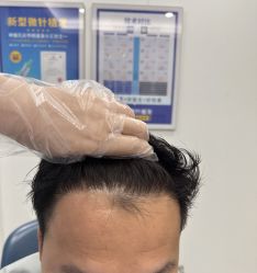 -大麦微针植发全国连锁