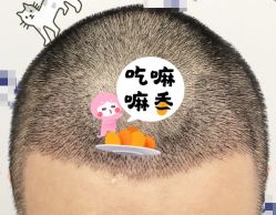 -大麦微针植发全国连锁