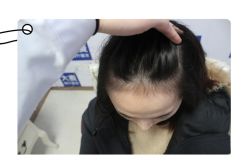 -大麦微针植发全国连锁