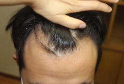 体验前-大麦微针植发全国连锁