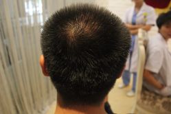 点击看大图 -大麦微针植发丨全国连锁