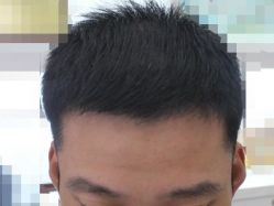-大麦微针植发全国连锁