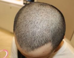 -大麦微针植发丨全国连锁