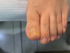 -Andrew指甲专科灰指甲·甲沟炎矫正·3D步态矫形鞋垫定制(浦三路店)