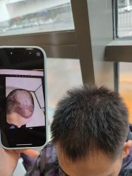 -碧莲盛·不剃发植发