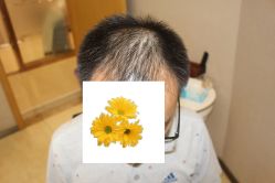-大麦微针植发丨全国连锁