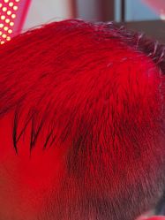 -碧莲盛·不剃发植发