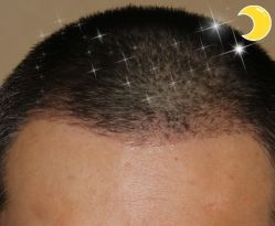 -大麦微针植发丨全国连锁