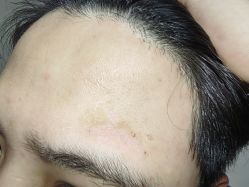 -一次性洗纹身·修复疤痕·超皮秒