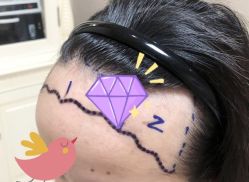 -大麦微针植发全国连锁