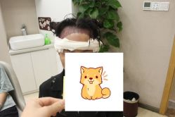 -大麦微针植发丨全国连锁