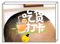 -大麦微针植发全国连锁