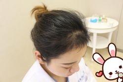 -大麦微针植发丨全国连锁