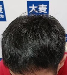 点击看大图 -大麦微针植发丨全国连锁