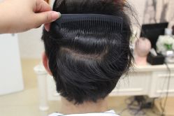 点击看大图 -大麦微针植发丨全国连锁