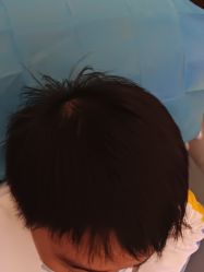 -碧莲盛·不剃发植发