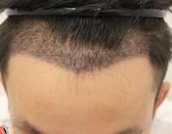 -大麦微针植发丨全国连锁