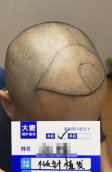 -大麦微针植发全国连锁