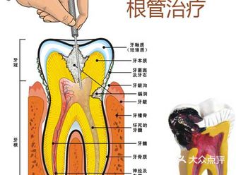 牙髓病和根尖周病首选根管治疗