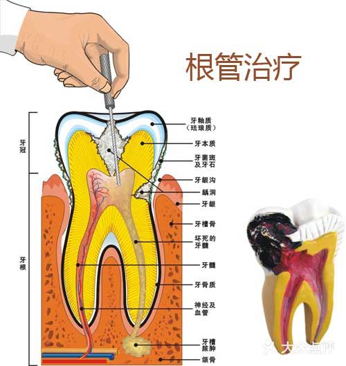 牙髓病和根尖周病首选根管治疗