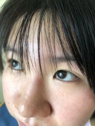 -美丽人生祛斑扁平疣汗管瘤中心